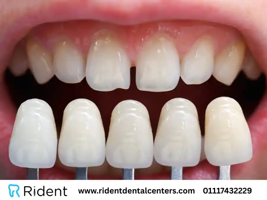 تجميل الاسنان بـ 11 طريقة مختلفة في ملف شامل